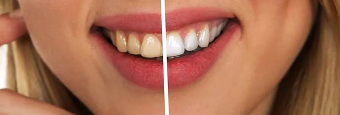 Вейпинг вреден для зубов? Фото-2